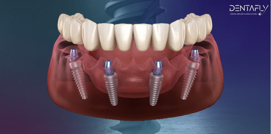 https://www.dentaflyklinik.com/wp-content/uploads/2023/10/all-on-4.jpg